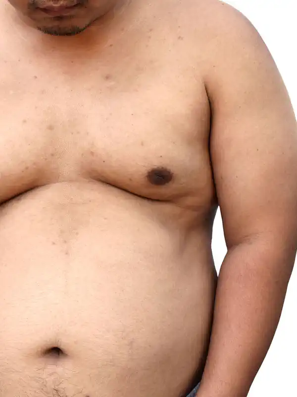 Gynecomastia